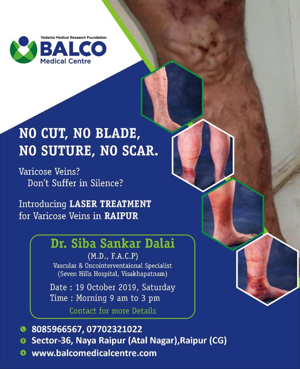 Event - Varicose Vein OPD by Dr Siba Sankar Dalai