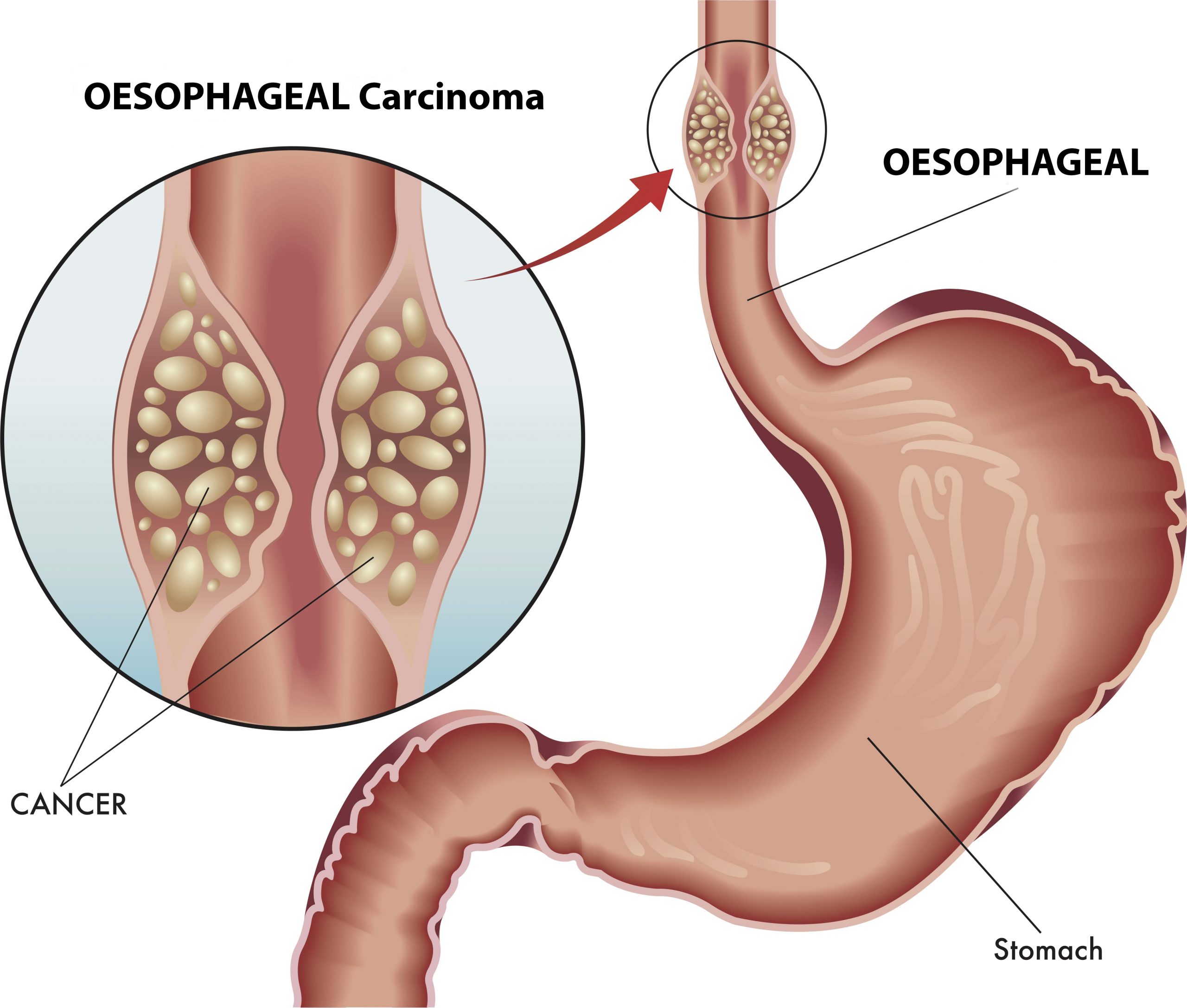 information-on-oesophagus-foodpipe-cancer