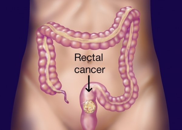 patient-information-on-rectal-cancer
