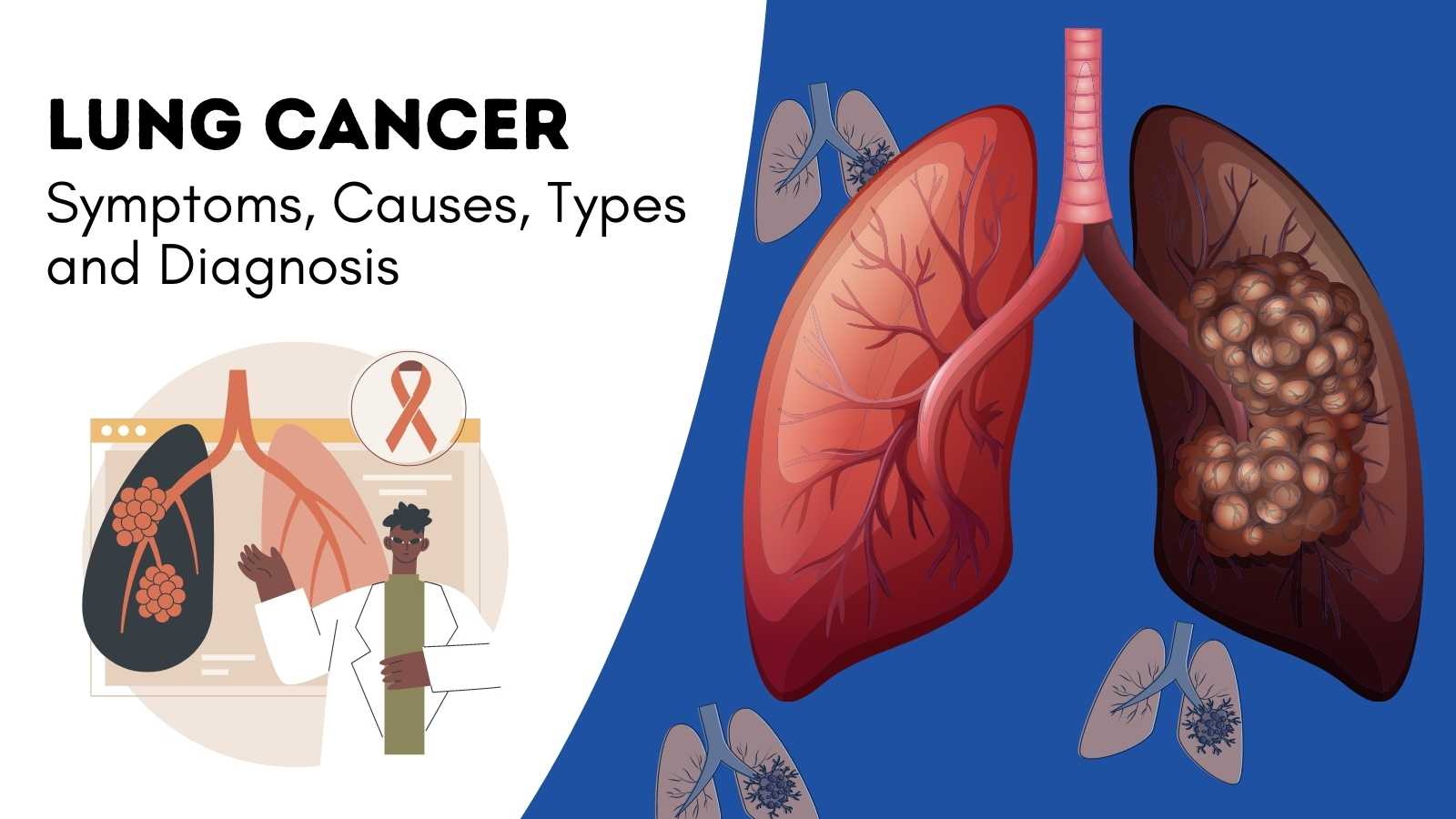 patient-information-on-lung-cancer